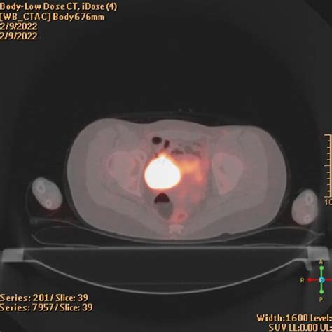 Positron Emission Tomography Computed Tomography Scan With Dotatate