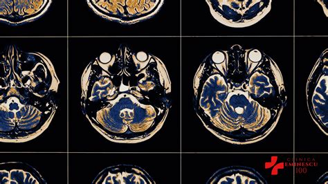 Rmn Cerebral Imagistica Neurologica Avansata Clinica Eminescu