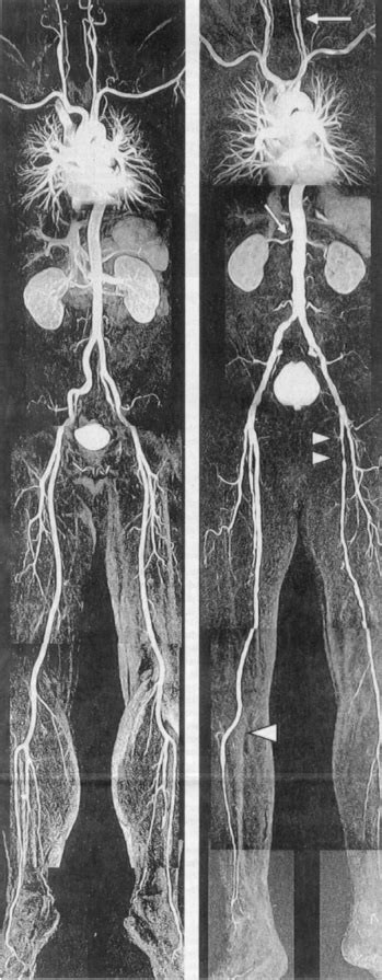 Angiography Of The Whole Body Performed By Clinical Magnetic Resonance Download Scientific