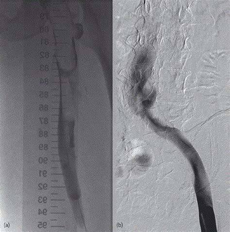 Phlegmasia Cerulea Dolens Percutaneous Treatment Challenging