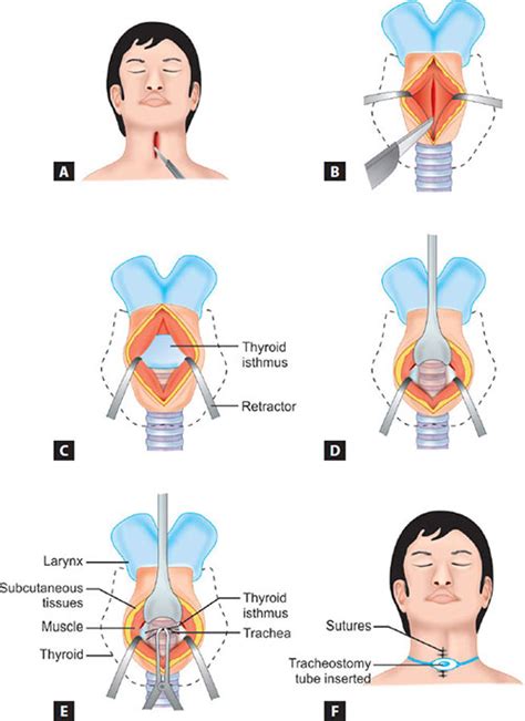 Tracheostomy Procedure Steps