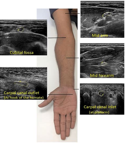 Ultrasound Images And Direct Tracing Of The Median Nerve Cross Download Scientific Diagram