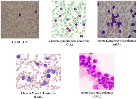 Diagnostics Free Full Text Identification Of Leukemia Subtypes From