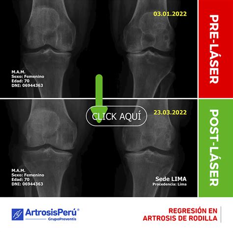 REGRESIÓN EN ARTROSIS DE RODILLA Fundación Preventis