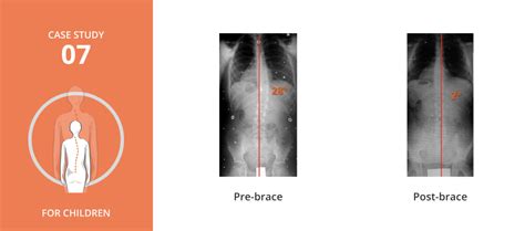 Pediatric Scoliosis Treatment - Scoliosis Centers of Boston MA and ...