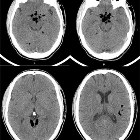 Axial Non Contrast Enhanced Ct Scan Showing Diffuse Pneumocephalus Air