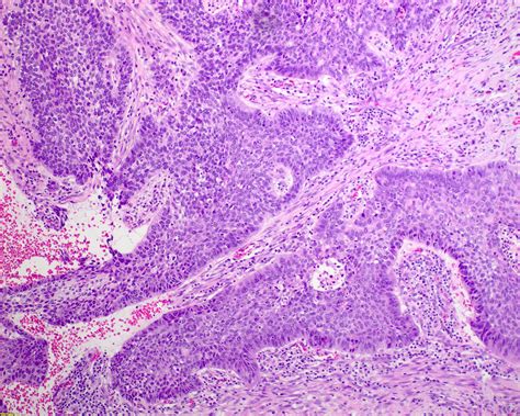 Small Cell Lung Cancer Histology