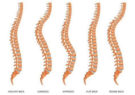 How To Improve Your Spine Alignment And Posture Mcposture