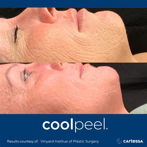 Cool Peel Co2 Laser Atlantic Aesthetics Maine