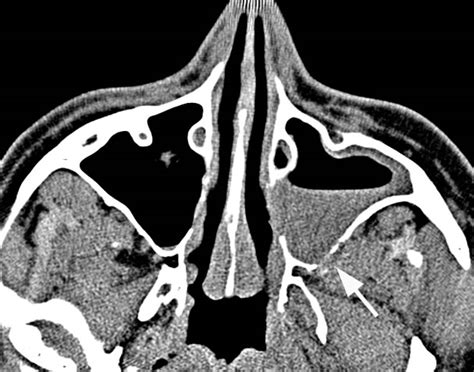 Maxillary Sinus Abnormal