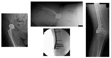 Case Study Of Periprosthetic Fracture Dr Nakul Karkare New York Usa