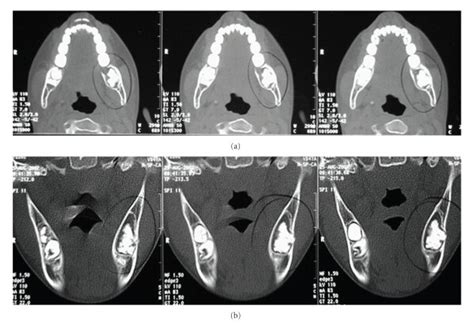 Helical Computed Tomography Images Showing An Expansile Download Scientific Diagram