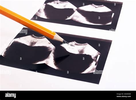 Prostate exam hi-res stock photography and images - Alamy