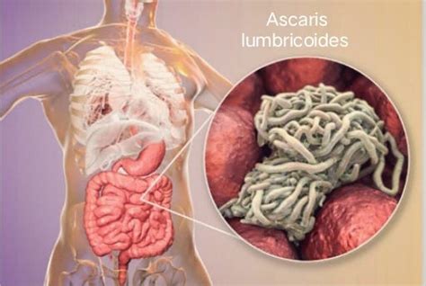 Ascaris Lumbricoides In Humans