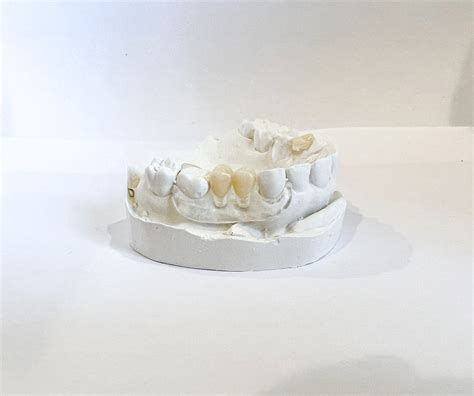 Clear Unilateral Partial Denture - Revived Smiles