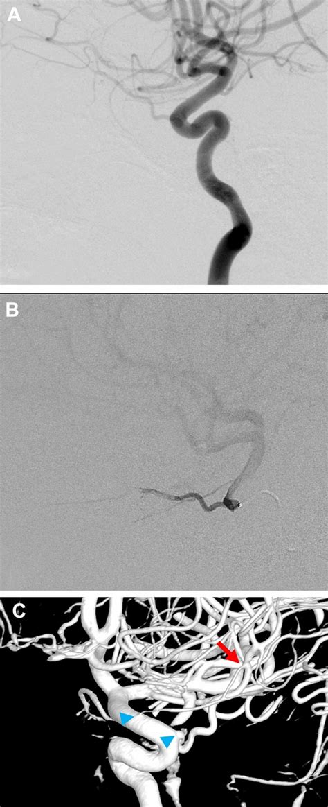 A Lateral View Of Left Internal Carotid Angiogram Is Suggestive Of Dual