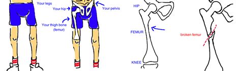 Femur Fracture — Bone Talks