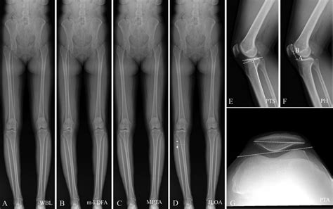 Radiographs Showing Measurements Of The A Weightbearing Line Wbl