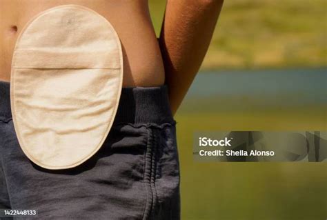 Woman With Colostomy Bag In The Mountains Stock Photo - Download Image ...