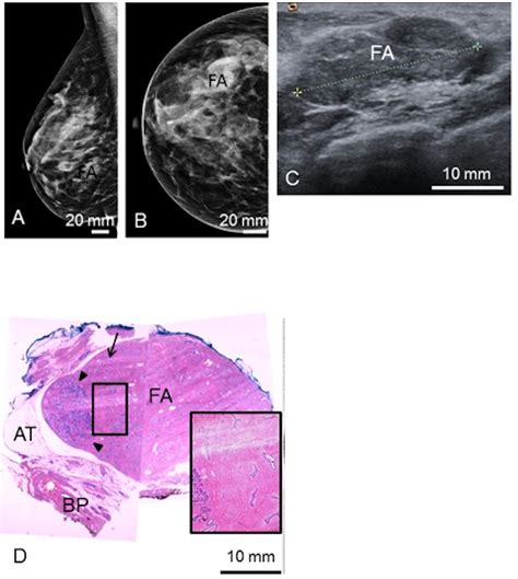 Fibroadenoma Concise Medical Knowledge