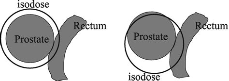 Randomized Trial Of High And Low Source Strength 125I Prostate Seed