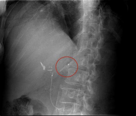 Pancreatoscopy Guided Laser Dissection And Ablation For Treatment Of Benign And Neoplastic