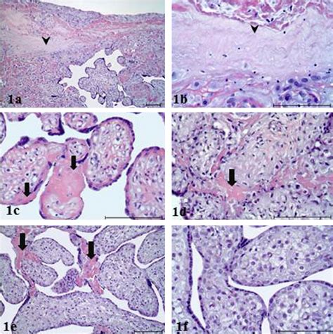 Hematoxylineosin He Stained Sections Of Iugr Group Term Placentas