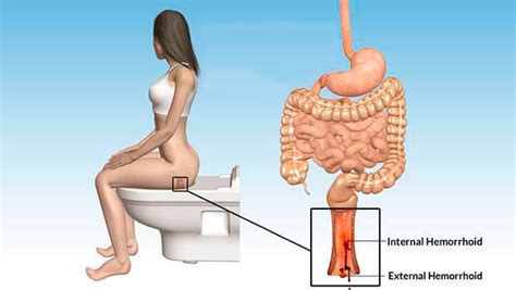 Female External Hemorrhoids