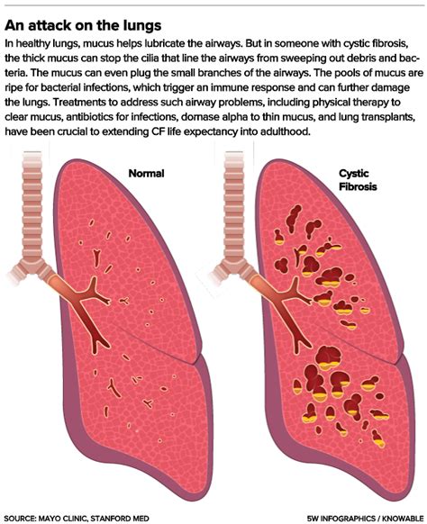 Cystic Fibrosis Lungs Vs Healthy Lungs