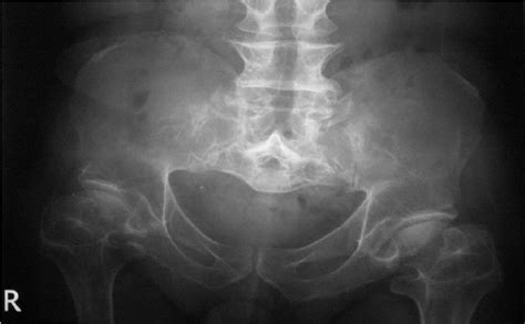 Plain Abdominal Radiograph In The Ach Patient Demonstrating An