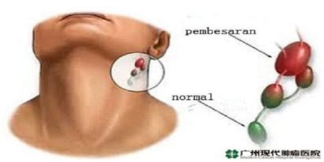 Mengenal Kanker Kelenjar Getah Bening Benjolan Di Leher Ketiak Dan