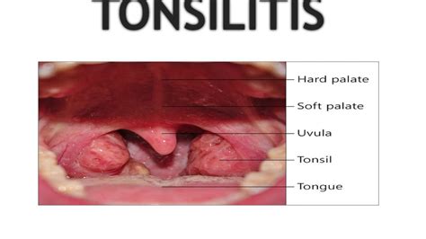 Tonsillitis Youtube