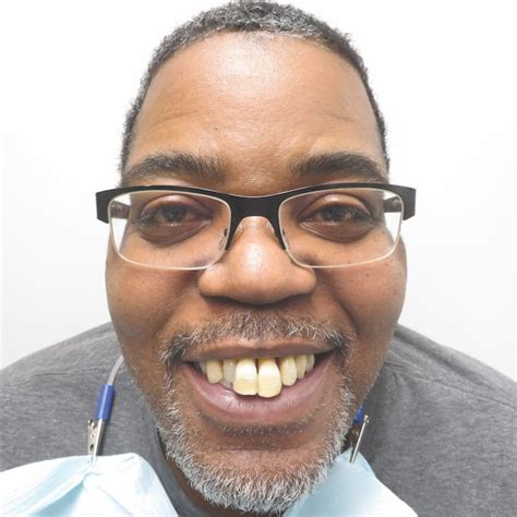 Renew Full Dental Implants And Dentures Beverly Hills Renew