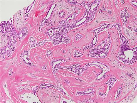 Mammotome Biopsy Showing Fibroelastic Stroma With Entrapped Small Ducts