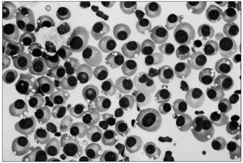 Cytospin Smears Of Pleural Fluid Showing Clusters Of Plasma Cells With Download Scientific