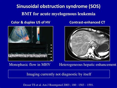 Doppler ultrasound of Budd Chiari syndrome & SOS