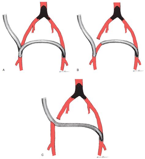 Surgicalcore Tablefigure