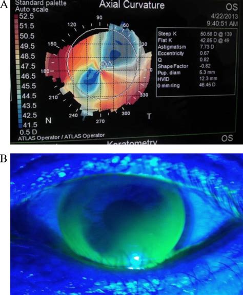 Bitoric Rigid Gas Permeable Contact Lenses In The Optical Management Of