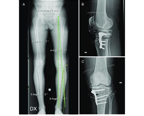 Preoperative And Postoperative Evaluation Of HTO A Mechanical Axis