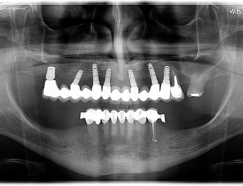 Bone Level Tapered 48 Straumann Implant Detective