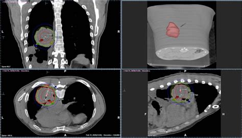 Interstitial HDR Brachytherapy Implant Of A 37 Years Old Patient With A