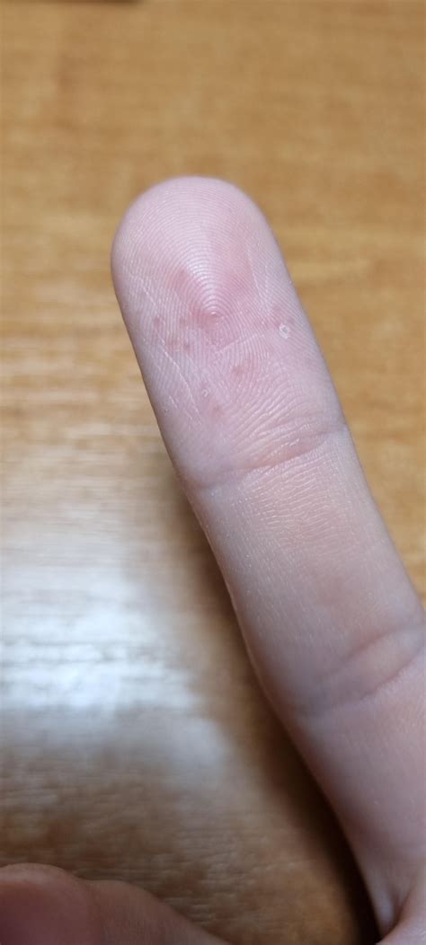 Small bumps appearing on my fingers, neither itchy nor painful, unless