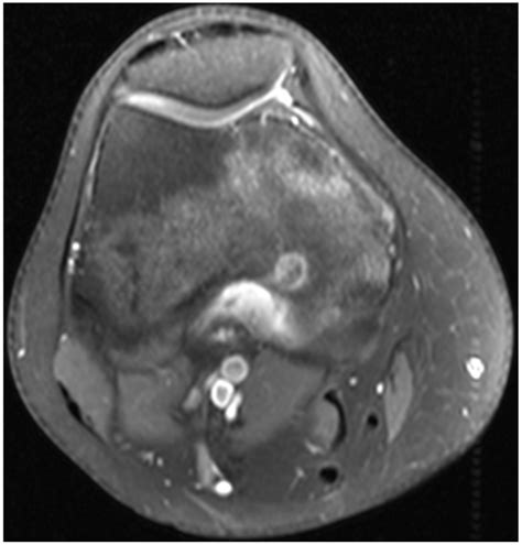 Medicina Free Full Text Osteoid Osteoma Treatment With Microwave