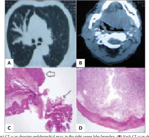 Figure From A Rare Synchronous Tumor Primary Squamous Cell Lung