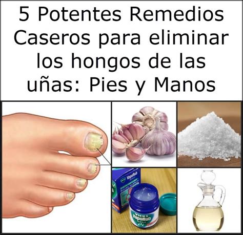 5 Potentes Remedios Caseros Para Eliminar Los Hongos De Las Uñas Pies Y Manos Hongos Pies