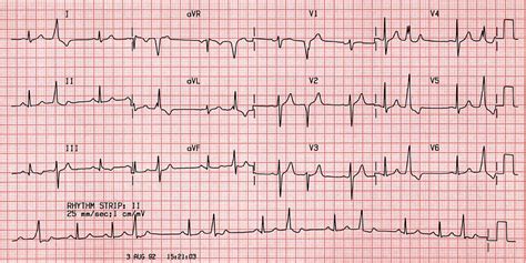 Case B21 Ventricular Premature Beats • Ecgs At St Emlyns