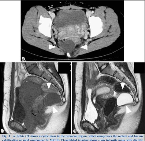 Figure 1 From An Adult Case Of Adult Presacral Dermoid Cyst Semantic