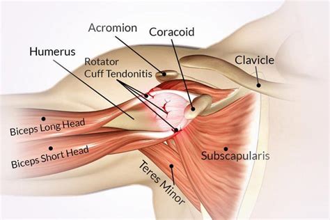 Impingement Syndrome Market Worldwide Industry Analysis