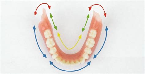 Lower Suction Dentures Brookswood Denture Clinic