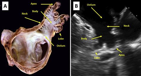 Left Atrial Appendage Occlusionexclusion Procedural Image Guidance